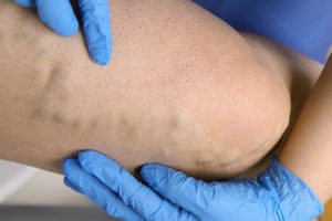 Should I get a varicose vein treatment 