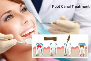 All You Need To Know About Root Canal Treatment - You Must Get Healthy