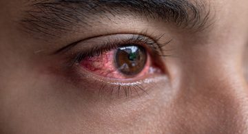 Home Remedies for Red and Itchy Eyes