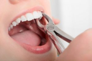 Tooth Extraction