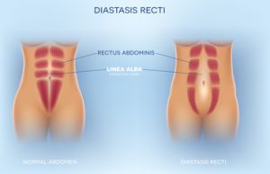 Diastasis Recti Repair