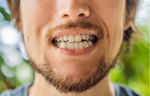Teeth Grinding and Its Long-Term Effects