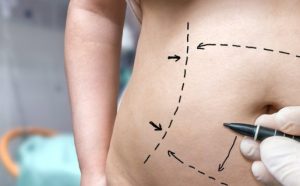 Things to consider before getting a tummy tuck