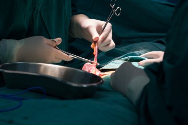 consider before undergoing appendectomy