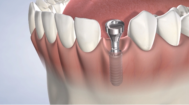 Why Consider Single Stage Dental Implants?