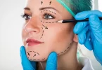 How to Speed Up Facelift Surgery Recovery
