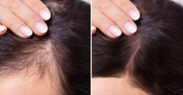 Does Provillus Hair Loss Treatment Really Work?