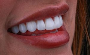 Types of Dental Crowns and Their Benefits