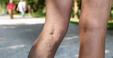 Health Tips for Varicose Veins