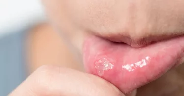 Natural Remedies for Mouth Sores
