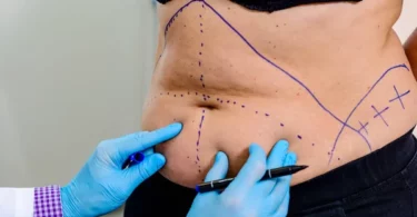 Exploring Non-Surgical Alternatives to Tummy Tucks: What’s New in Body Contouring?