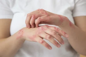 10 Facts About Eczema Everyone Needs to Know