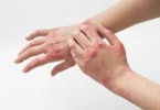 Facts About Eczema Everyone Needs to Know