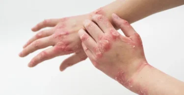 Facts About Eczema Everyone Needs to Know