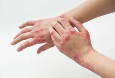 Facts About Eczema Everyone Needs to Know