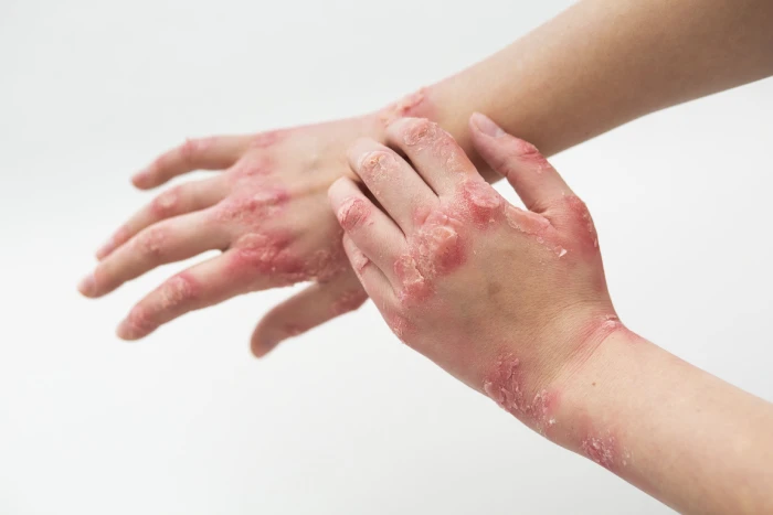 Facts About Eczema Everyone Needs to Know