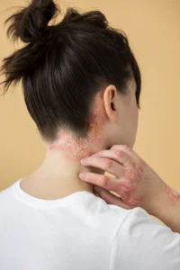 Facts About Eczema Everyone Needs to Know